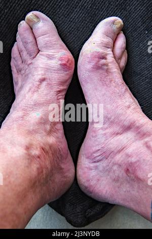 Älterer Pflegeheim, der seine Bunions ....progressive-Deformität in seinem Fall vererbt zeigte Stockfoto