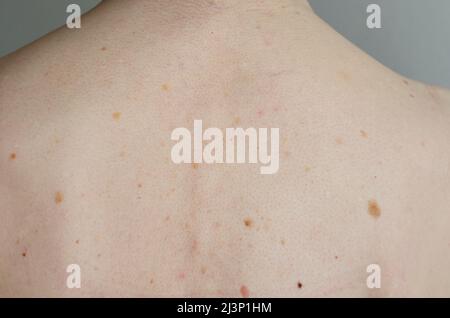 Maulwürfe auf dem Rücken einer weißen Frau Stockfoto