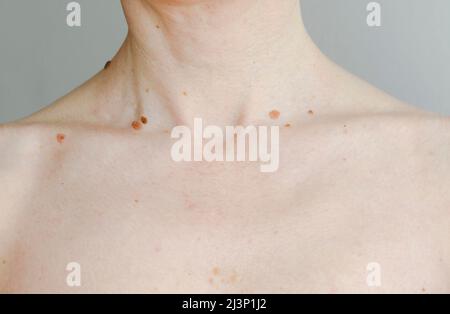 Maulwürfe auf weißer weiblicher Haut, die Nacken und Schultern zeigen. Stockfoto
