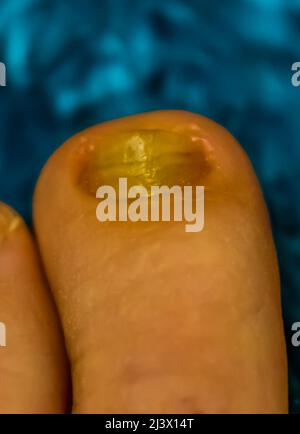 Makro-Nahaufnahme eines pilzbefallenen Zehennagels, häufige Infektionen und Krankheiten Stockfoto