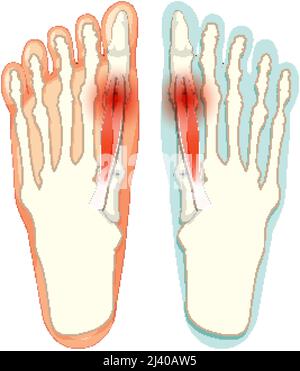 Hallux valgus Typen auf weißem Hintergrund Illustration Stock Vektor