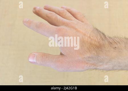 Nahaufnahme der gebrochenen Hand eines Mannes. Stockfoto