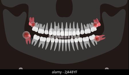 Menschliches Röntgenbild der Zähne, Vektordarstellung;, entzündete Zähne des Menschen, Es tut weh im Mund Stock Vektor