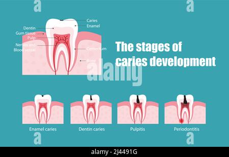 Die Stadien des Karies, Vektordarstellung Stock Vektor