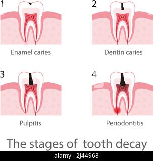 Die Stadien des Karies, Vektordarstellung Stock Vektor