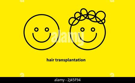 Haartransplantation, Doodle-Symbol. Kopf mit Glatze und mit im Haar, Vergleich vor und nach Haartransplantation Stock Vektor