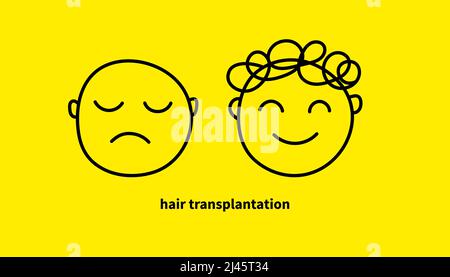 Haartransplantation, Doodle-Symbol. Kopf mit Glatze und mit im Haar, Vergleich vor und nach Haartransplantation Stock Vektor