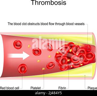 Thrombose. Das Blutgerinnsel behindert den Blutfluss durch die Blutgefäße. Querschnitt des Blutgefäßes mit atherosklerotischer Plaque, roten Blutkörperchen, Pla Stock Vektor