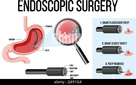 Abbildung zeigt die Illustration einer endoskopischen Operation Stock Vektor