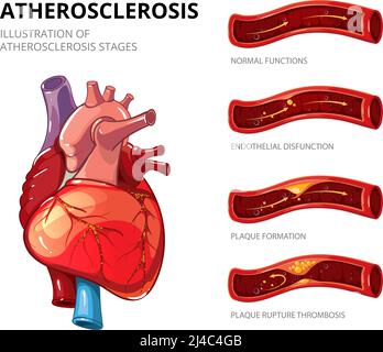 Atherosklerose. Bildung von faseriger Plaque. Medizinischer Mensch, Gesundheitsgrafik, Thrombus im Gefäß. Infografik zur Vektorgrafik Stock Vektor