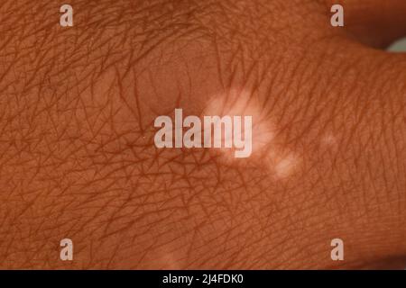 Vitiligo ist ein Zustand, bei dem die Haut ihre Pigmentzellen (Melanozyten) verliert. Vitiligo tritt auf, wenn pigmentproduzierende Zellen sterben oder nicht mehr funktionieren. Stockfoto