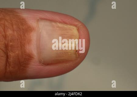 Der Zustand des verplatteten Nagels kann sich auf andere Erkrankungen beziehen. Stockfoto
