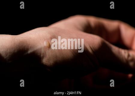 Blister aus brenner Hand Blister Nahaufnahme. Blister durch Brandmarke auf der Hand verursacht. Stockfoto