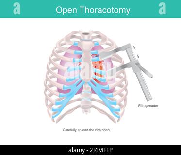 Offene Thorakotomie. Ein Verfahren, um Zugang zum Pleuraraum der menschlichen Brust durch ein medizinisches Werkzeug namens Rippenstreuer zu erhalten. Stock Vektor