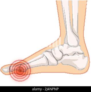 Hallux valgus Typen auf weißem Hintergrund Illustration Stock Vektor