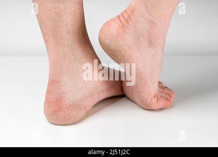 Trockene und rissige Fußsohlen auf weißem Hintergrund, Männerfüße mit trockenen Fersen, rissige Haut. Nahaufnahme von Rissen auf den Fersen mit schlechter Haut bedeckt. Healthcar Stockfoto