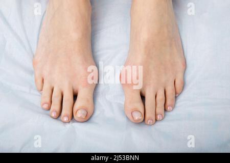 Die Frau leidet an einer Entzündung des großen Zehenknochens. Hallux valgus, Bunion im Fuß auf weißem Hintergrund. Stockfoto