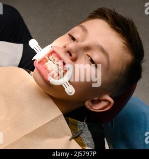 Besuch beim Kieferorthopäden, Installation von Zahnspangen an den oberen Zähnen, weißer Retraktor auf den Lippen des Kindes, Ausrichtung der Zähne. Stockfoto