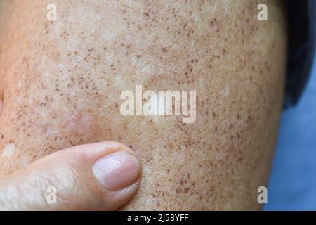 Weißer Fleck am Arm des älteren asiatischen Mannes. Stockfoto