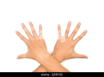 Spastische Hand. Spastizität der Handmuskulatur. Konzept der Gesundheit der Hand- und Fingergelenke. Stockfoto