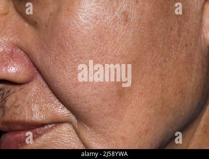 Vergrößerte Poren im öligen Gesicht des südostasiatischen, chinesischen älteren Mannes mit Hautfalten. Stockfoto