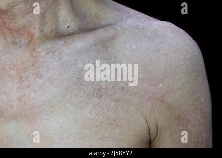Altersflecken und weiße Flecken auf der Brust des älteren asiatischen Mannes. Altersruten sind braune, graue oder schwarze Flecken und werden auch als Leberflecken, senile Linsen, Solar bezeichnet Stockfoto