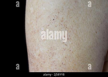 Altersflecken und weiße Flecken am Arm des älteren asiatischen Mannes. Altersflecken sind braune, graue oder schwarze Flecken und werden auch als Leberflecken, senile Linsen, Sonnenflecken bezeichnet Stockfoto
