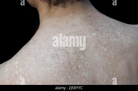 Altersflecken und weiße Flecken auf dem oberen Rücken des älteren asiatischen Mannes. Altersflecken sind braune, graue oder schwarze Flecken und werden auch als Leberflecken, senile Lentigo, s bezeichnet Stockfoto