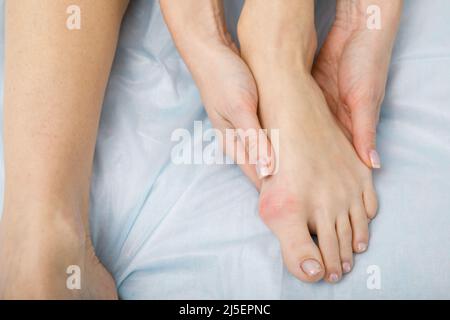 Die Frau leidet an einer Entzündung des großen Zehenknochens. Hallux valgus, Bunion im Fuß auf weißem Hintergrund. Stockfoto