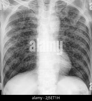 Miliarknochen, Röntgen Stockfoto