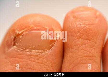 Eingewachsene Zehennagel der großen Zehe des rechten Fußes ist ein häufiger Zustand, in dem die Ecke oder Seite eines Zehennagels wächst in das weiche Fleisch Ergebnis in pa Stockfoto