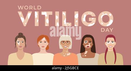 World Vitiligo Tag Juni 25 Banner. Weibliche Gesichter mit verschiedenen Ethnien, Hautfarben, Frisuren mit Vitiligo Hautkrankheit. Body-positive-Konzept. Fla Stock Vektor