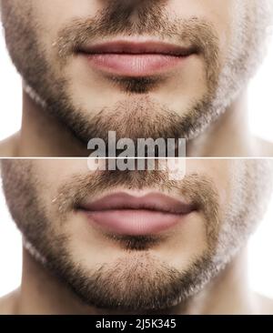 Ergebnis der Lippenvergrößerung. Männliche Lippen vor und nach der Füller-Injektion. Stockfoto