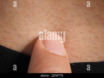 Warzenentfernung. Makroaufnahme von Warzen in der Nähe von Auge auf Gesicht. Papillom auf der Haut um die Nase und den Hals des Auges. Muttermal Papilla oder Maulwurf auf der Haut. Klein hart. Be Stockfoto