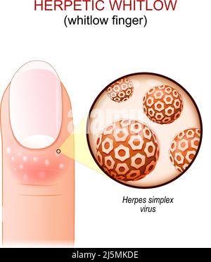 Herpetischer Weißlut. Weißer Finger. Finger des Menschen mit Hautkrankheit. Nahaufnahme von Virionen des Herpes-simplex-Virus. vektordarstellung Stock Vektor