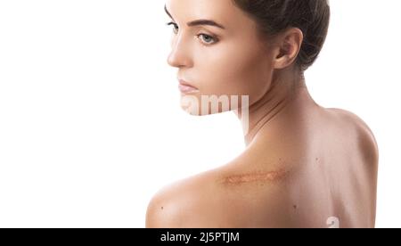 Junge Frau mit einer Narbe auf der Schulter Stockfoto