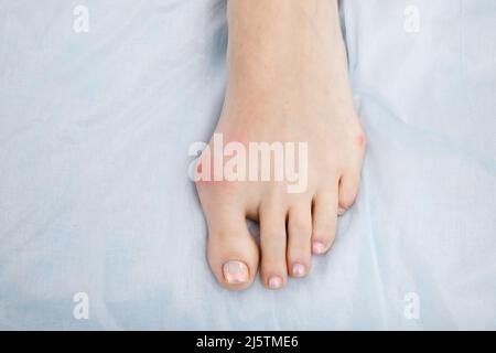 Die Frau leidet an einer Entzündung des großen Zehenknochens. Hallux valgus, Bunion im Fuß auf weißem Hintergrund. Stockfoto