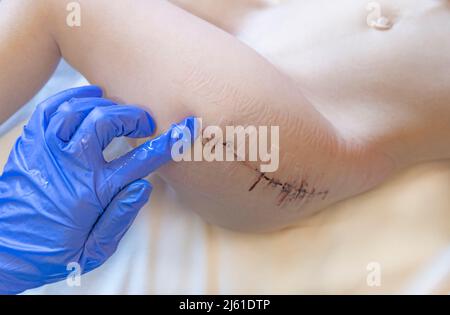 Nahaufnahme der menschlichen Haut mit Streifen für Nähte und Wundverschluss oder Operationsband nach einer Operation am Bein eines Kindes. Stockfoto