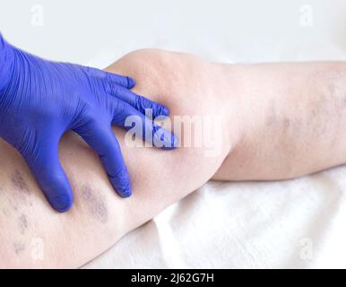 Der Arzt untersucht das Bein eines Patienten mit Krampfadern und Venenthrombose. Behandlung von Krampfadern Stockfoto