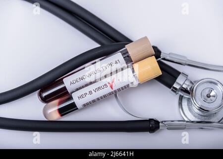 Verdacht auf Adenovirus als Schuldige bei der Hepatitis im Kindesalter unbekannter Herkunft. Hepatisch, sars-cov2. Stockfoto