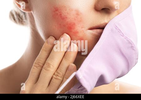 Maskne - Akne Ausbrüche aus dem Tragen einer Gesichtsmaske Stockfoto