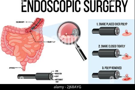 Abbildung zeigt die Illustration einer endoskopischen Operation Stock Vektor