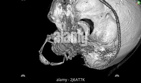 Gebrochener Hyoidknochen, 3D CT-Scan Stockfoto