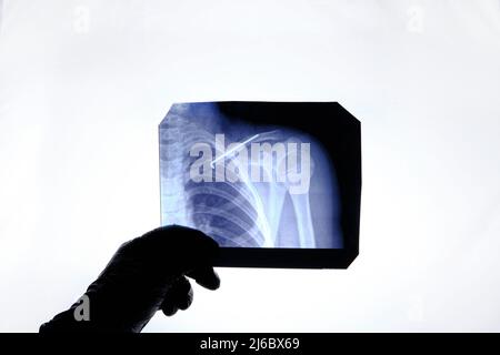 Röntgenbild Person mit gebrochenem Schlüsselbein und Spoke installiert in es nach der Operation Stockfoto