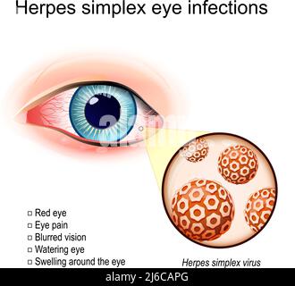 Herpes simplex Augeninfektionen. Ein rotes Menschenauge mit Schwellung um. Nahaufnahme des Herpes-simplex-Virus. Virionen, die Infektion Krankheit des Auges verursacht. Stock Vektor