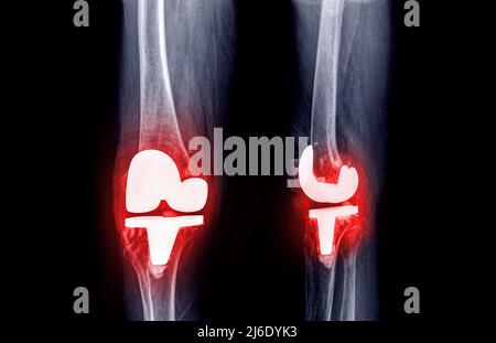 Filmen Sie das Röntgenknee AP und die laterale Ansicht des Arthrose-Kniepatienten und des künstlichen Gelenks mit Knieersatz. Stockfoto