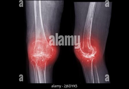 Film X-ray Knie AP und laterale Ansicht von Arthrose Knie-Patienten und künstliches Gelenk . Stockfoto