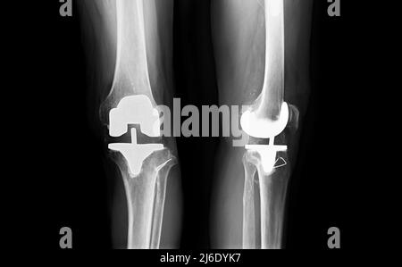 Filmen Sie das linke Knie AP und die laterale Ansicht des Arthrose-Kniepatienten und des künstlichen Gelenks mit Knieersatz. Stockfoto