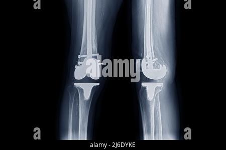 Filmen Sie das rechte Knie AP und die laterale Ansicht von Arthrose-Kniepatienten und künstlichem Gelenk mit Knieersatz. Stockfoto