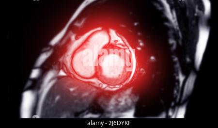 MRT Herz- oder Herz-MRT (Magnetresonanztomographie) der kurzen Herzachse zur Diagnose von Herzerkrankungen. Stockfoto